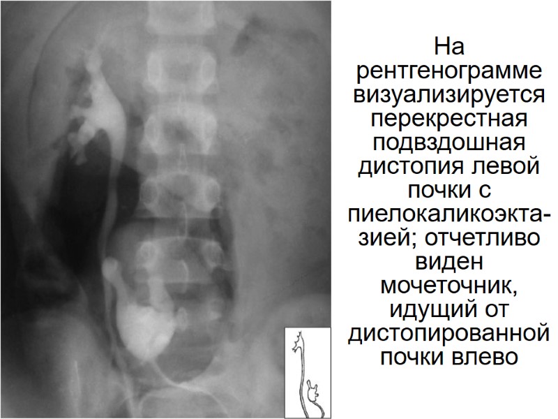 На рентгенограмме визуализируется перекрестная подвздошная дистопия левой почки с пиелокаликоэкта-зией; отчетливо виден мочеточник, идущий